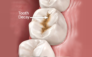 Tooth Decay Prevention